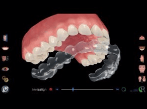 nhung thay doi, chinh sua va lap ke hoach dieu tri cho benh nhan se duoc soan thao va goi y boi may vi tinh va ky thuat vien invisalign. tuy vay, bac si chinh nha tai viet nam moi la nguoi xac nhan ke hoach dieu tri va co trach nhiem dieu tri cho benh nhan