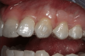 sau khi mang khay invisalign