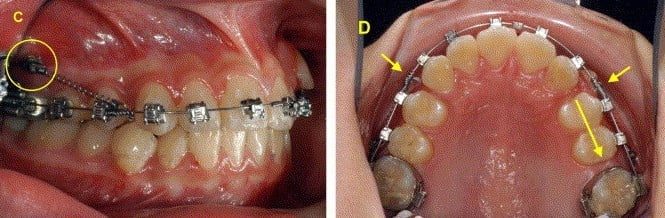 dat mini implant_nkla