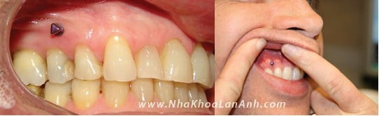 Mini screw được đặt trong miệng có kích thước nhỏ gọn, nên gần như không ảnh hưởng đến sinh hoạt của bệnh nhân. Dĩ nhiên, mini screw phải được đặt đúng cách và chỉ định bởi bác sĩ chỉnh nha.