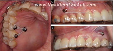 Hình: Mini screw dùng để lún răng cối lớn và kéo lùi hàm Invisalign