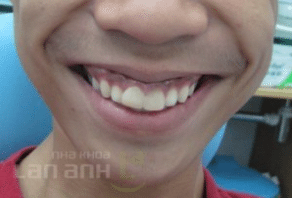 hinh: hinh anh benh nhan da dieu tri tai nha khoa lan anh. chi trong thoi gian 18 thang, ke hoach dieu tri da hoan thanh voi ket qua kha tot. benh nhan van thuong xuyen quay lai tai kham va ket qua van duoc duy tri tot.