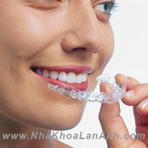 Chinh nha bang Invisalign