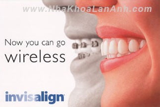 hinh: khoang 5-10% benh nhan mang mac cai phan nan ve giong noi cua minh do mac cai hoac day cung co xat vao moi khi noi va phat am. voi invisalign, ban chi can thao khay la da 