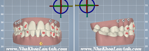 hinh: mot ca dieu tri ho 2 ham voi chi dinh nho rang so 8 (rang khon) de dieu tri bang invisalign. neu su dung mac cai co dien, bac si thuong chi dinh nho 4 rang so 4 hoac rang so 5 de lui ham, dong thoi nho 4 rang so 8 (rang khon) de khop can duoc on dinh. nhu vay benh nhan phai nho 8 rang. trong truong hop nay, dieu tri bang invisalign giup rang cua lui 5mm (xem tren clincheck) ma chi can nho 4 rang khon, va thoi gian dieu tri cung chi 18 thang.