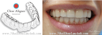 hinh: khay clear aligner thuong duoc lam mong va nhe hon khay invisalign, nen giup dat duoc do tham my rat cao va duoc lam khay duy tri cho benh nhan sau chinh nha.