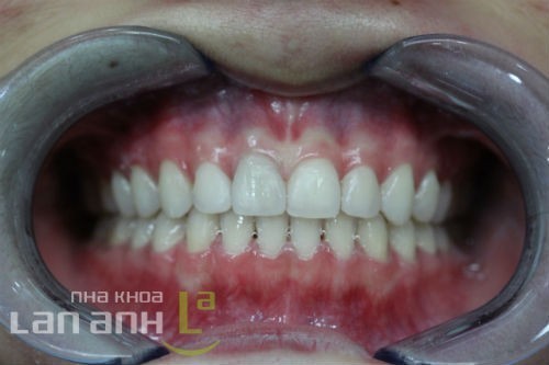 Bệnh nhân được tháo mắc cài benh nhan duoc thao mac cai chinh nha