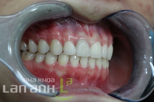 Tháo mắc cài chỉnh nha thao mac cai chinh nha