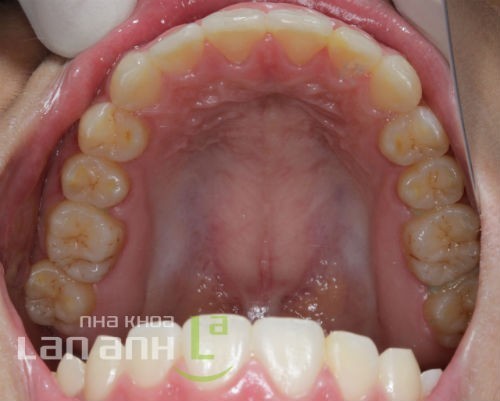 Điều trị khớp cắn hở dieu tri khop can ho1