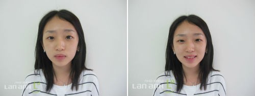 Gắn mắc cài cho bệnh nhân chỉnh nha gan mac cai cho benh nhan chinh nha