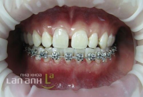 Khớp cắn bệnh nhân khi gắn mắc cài khop can benh nhan khi gan mac cai chinh nha
