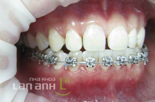 Hệ thống mắc cài tự buộc he thong mac cai tu buoc de chinh nha