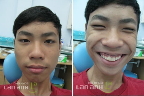 Kế hoạch chỉnh nha không nhổ răng ke hoach chinh nha khong nho rang