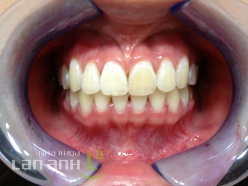 Kết thúc quá trình điều trị chỉnh nha ket thuc qua trinh dieu tri chinh nha