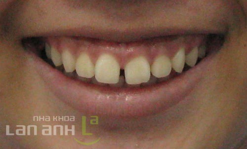Khe hở hàm răng khe ho ham tren truoc khi chinh nha