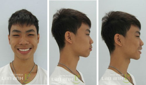 Khuôn mặt với nụ cười mới khuon mat voi nu cuoi moi sau khi chinh nha