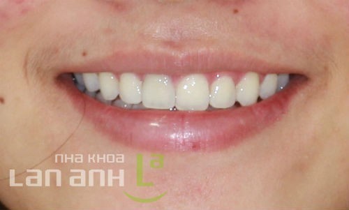 Nụ cười sau khi được tháo mắc cài chỉnh nha nu cuoi sau khi duoc thao mac cai chinh nha