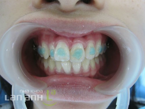 Phân tích mẫu hàm chỉnh nha phan tich mau ham chinh nha