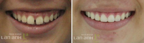 Trước và sau khi điều trị chỉnh nha truoc va sau khi dieu tri chinh nha