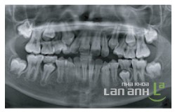 Chụp phim khảo sát răng Chup phim khao sat rang truoc khi chinh nha