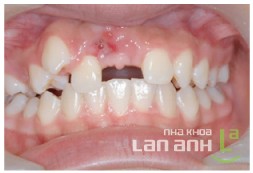 Hàm trên thiếu răng cửa vĩnh viễn Ham tren thieu rang cua vinh vien