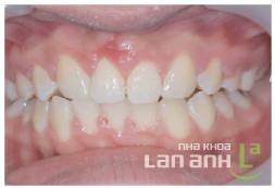 Kết quả sau khi chỉnh nha Ket qua sau khi chinh nha