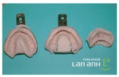 Lấy dấu răng chỉnh nha Lay dau rang chinh nha