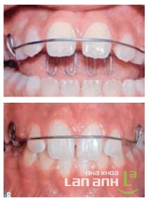Một số khí cụ tháo lắp, chỉnh nha Một loại khí cụ tháo lắp, chỉnh nha, tag: nha khoa uy tín tphcm, mất răng