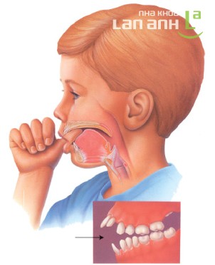Tật mút ngón tay ở trẻ em Tật mút tay ở trẻ em và phương pháp chỉnh nha uy tín