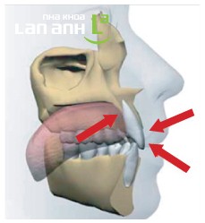Thói quen xấu làm sai lệch răng Thói quen xấu làm hư hại răng, phương pháp chỉnh nha uy tín tại Nha khoa Lan Anh
