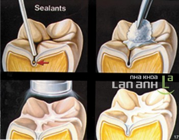Răng trước và sau trám sealant rang truoc va sau tram sealant