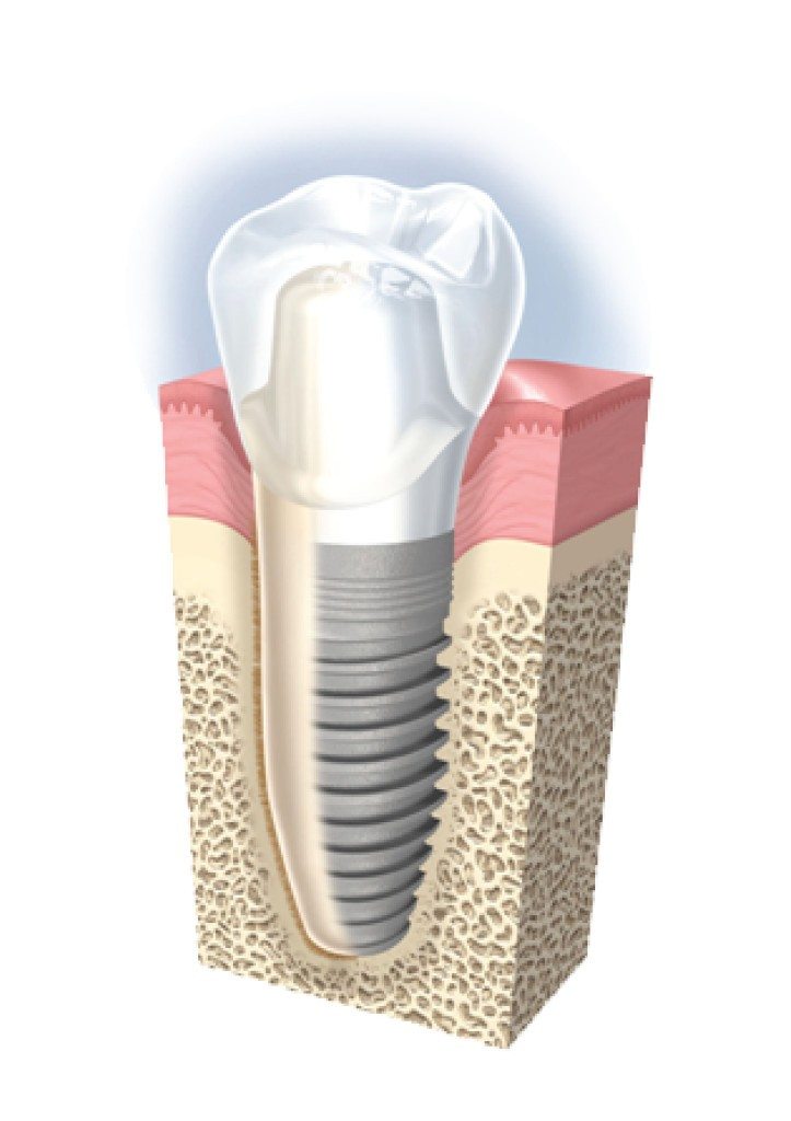cay ghep implant cho rang. tag: rang su nao tôt, nha khoa tốt ở tphcm