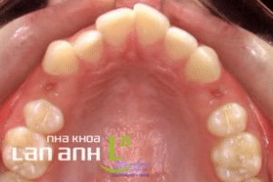 hinh: rang nho de chinh nha duoc nho nhe nhang, em ai, khong anh huong den nuou rang va cac cau truc xung quanh, giup cho viec di chuyen rang de dang.