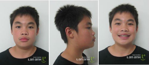Benh nhan co nu cuoi tham my
