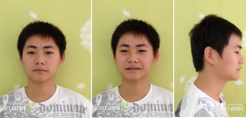 Benh nhan nam rang chen chuc