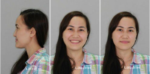 Dieu chinh lai khop can tot