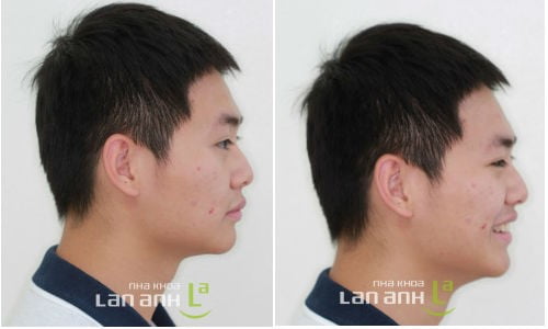 Sau khi chinh nha 17 thang