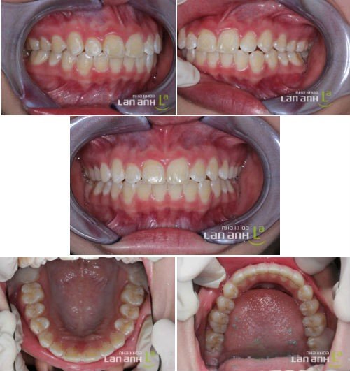 Sau khi chinh nha trong 20 thang- nha khoa tốt ở tphcm