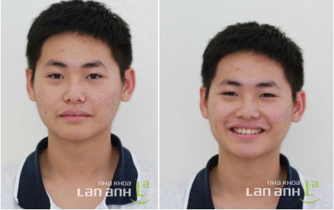Tinh trang rang chen chuc nhieu