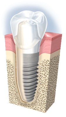 Kien thuc ve dat Implant
