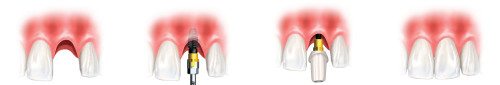 Quy trinh dat Implant
