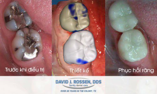 Ba giai doan chinh cua Cerec