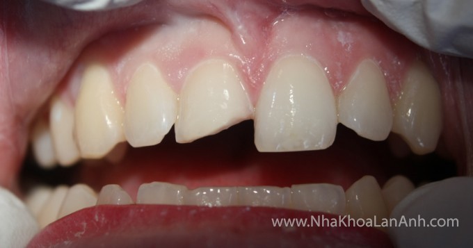 mot ca thuc te veneer mong 0.6mm de phuc hinh rang me goc.