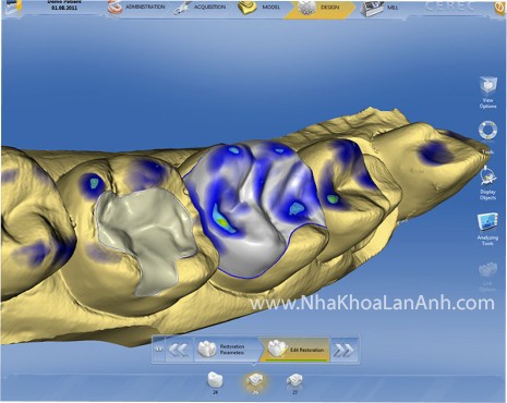 cerec1