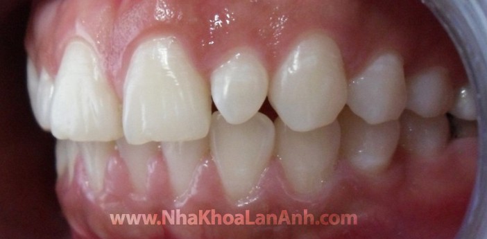 hinh: benh nhan co khe ho giua cac rang cua, rang cua ben di dang hinh chem.