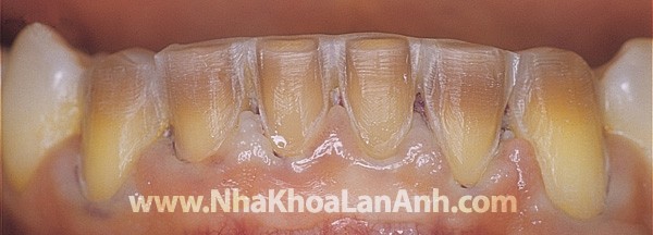 hinh: rang sau khi mai de lam veneer. do day cua veneer phai dong deu, mong, va veneer phai che duoc mau tetracycline.