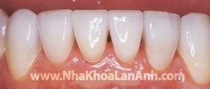 hinh: veneer sau khi duoc gan. nho che mau tot, mau sac dat duoc tu nhien. nho thiet ke tren may vi tinh, phan tiep xuc giua cac rang rat tot, giup de ve sinh giua cac ke rang.