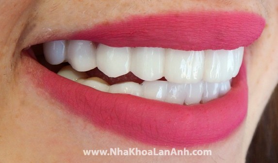 mau rang trang kieu hollywood smile
