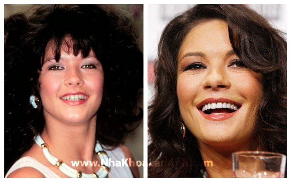 hinh: mau rang trang hollywood smile