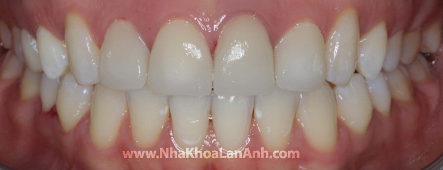 hinh: sau khi dieu tri, khop can benh nhan tot, tham my dat duoc tot, mac du ket hop giua 1 mao su va 3 veneer.